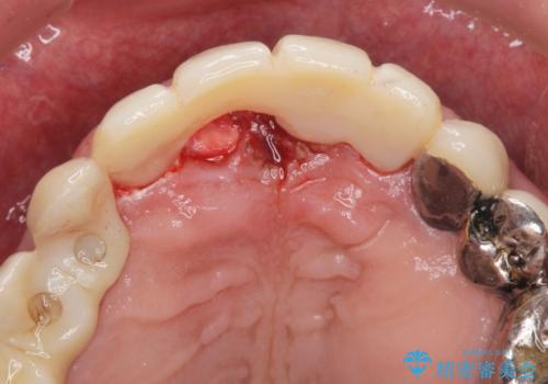 前歯がグラグラする。の治療中