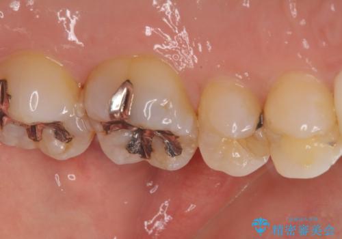 歯に穴があいてフロスが引っかかる　セラミックインレー修復の症例 治療前