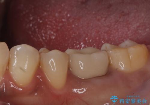 銀歯がとれた セラミックインレーで修復の治療後