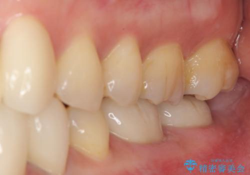 歯に穴があいてフロスが引っかかる　セラミックインレー修復の治療前