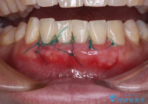 下がってきた歯茎を何とかしたい　歯肉移植による歯肉退縮の改善の治療中