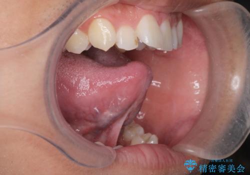 舌が動かしにくい。の治療前