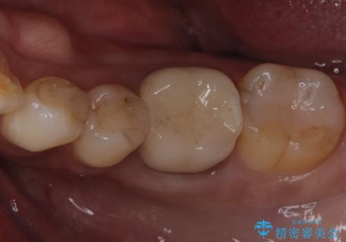 銀歯がとれた セラミックインレーで修復の治療後