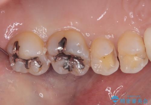 歯に穴があいてフロスが引っかかる　セラミックインレー修復