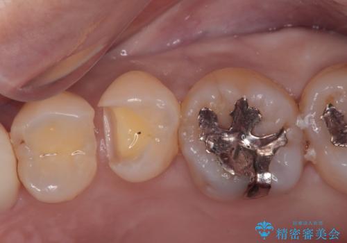 歯に穴があいてフロスが引っかかる　セラミックインレー修復の治療中