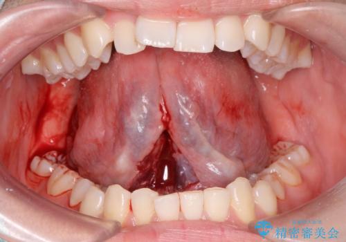 舌が動かしにくい。の治療中