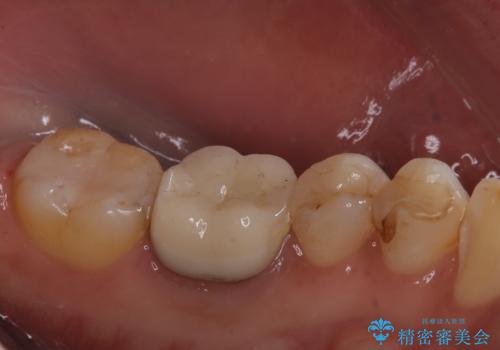 銀歯がとれた セラミックインレーで修復の治療後