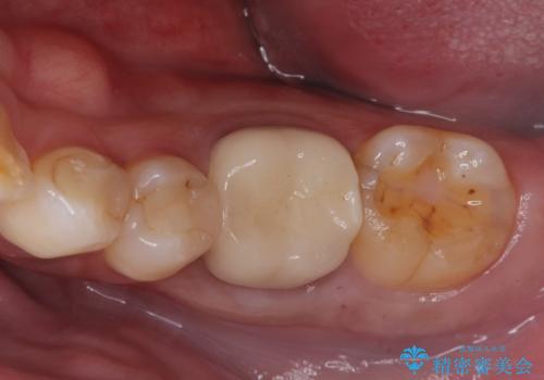 銀歯がとれた セラミックインレーで修復の治療中