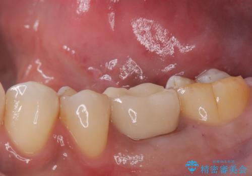 銀歯がとれた セラミックインレーで修復の治療中