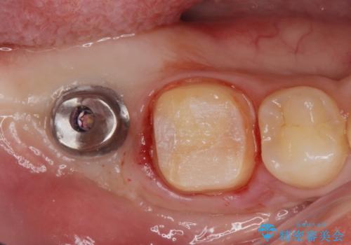 銀歯を白くしたい。(インプラント治療)の治療中
