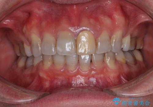 突出した前歯を引っ込める　ワイヤー装置での抜歯矯正の症例 治療後