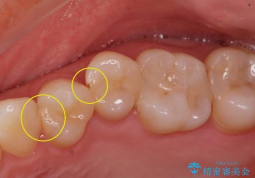 e-maxインレー治療の治療前