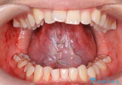 舌が動かしにくい。の治療中