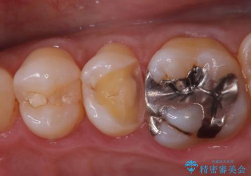 【セラミックインレー】他院で詰めた銀歯がフロスをしたら取れた!の治療中