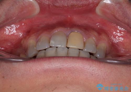 突出した前歯を引っ込める ワイヤー装置での抜歯矯正の治療後