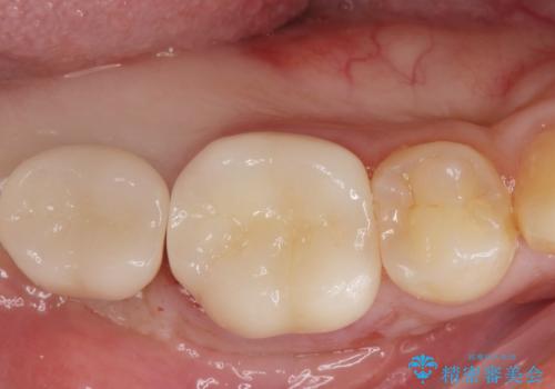 銀歯を白くしたい。(インプラント治療)の症例 治療後