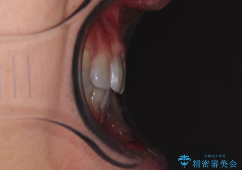 突出した前歯を引っ込める ワイヤー装置での抜歯矯正の治療後