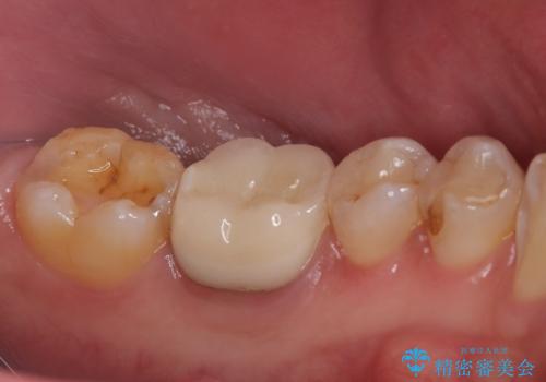 銀歯がとれた セラミックインレーで修復の治療中