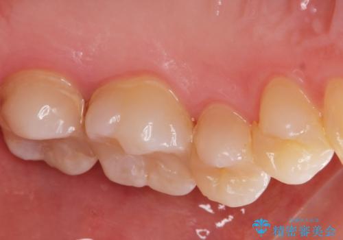 e-maxインレー治療の治療前