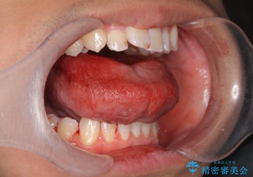 舌が動かしにくい。の治療中