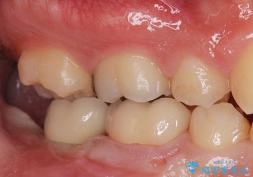 銀歯を白くしたい。(インプラント治療)の治療後