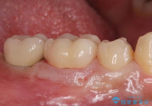 銀歯を白くしたい。(インプラント治療)の治療後