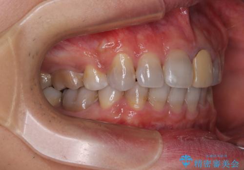 突出した前歯を引っ込める　ワイヤー装置での抜歯矯正の治療後