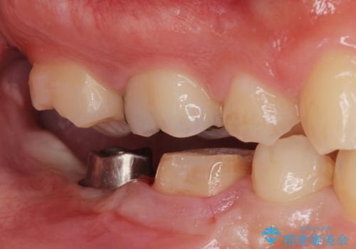 銀歯を白くしたい。(インプラント治療)の治療中