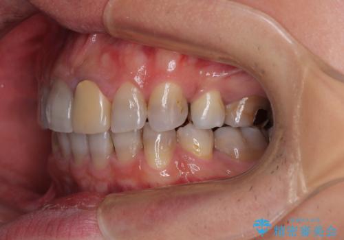 突出した前歯を引っ込める ワイヤー装置での抜歯矯正の治療後