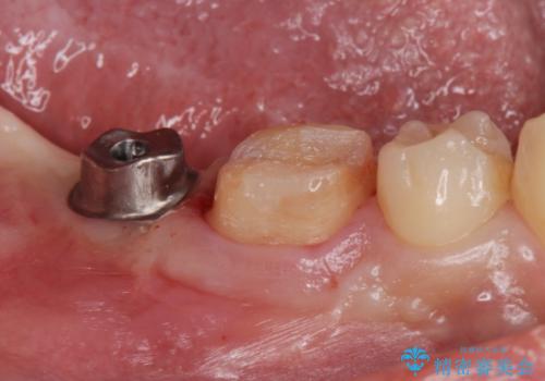 銀歯を白くしたい。(インプラント治療)の治療中