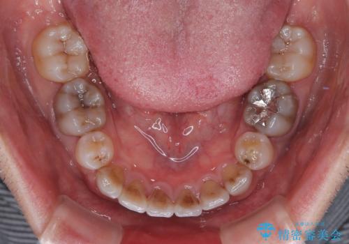 突出した前歯を引っ込める ワイヤー装置での抜歯矯正の治療後