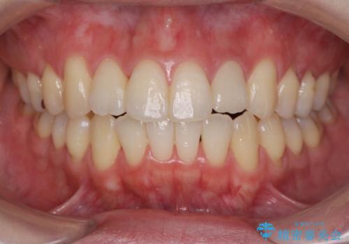 引っ込んだ前歯を並べたい　マウスピースと部分ワイヤーのコンビネーション矯正の症例 治療後