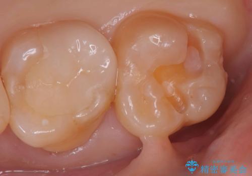 【セラミックインレー】咬合面のカリエスの治療中