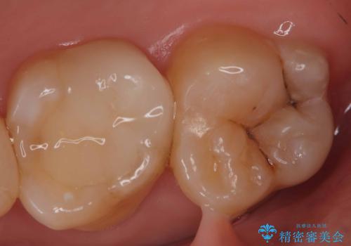 【セラミックインレー】咬合面のカリエスの症例 治療前