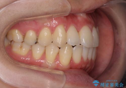 引っ込んだ前歯を並べたい マウスピースと部分ワイヤーのコンビネーション矯正の治療後