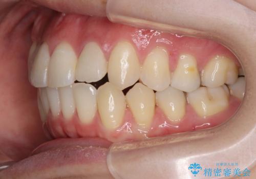 引っ込んだ前歯を並べたい　マウスピースと部分ワイヤーのコンビネーション矯正の治療後