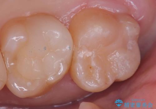 【セラミックインレー】咬合面のカリエスの症例 治療後