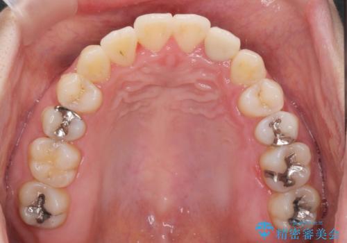 引っ込んだ前歯を並べたい マウスピースと部分ワイヤーのコンビネーション矯正の治療後