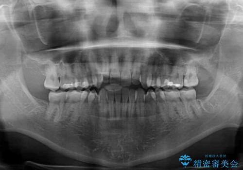 【モニター】オープンバイトをインビザライン矯正で治すの治療前
