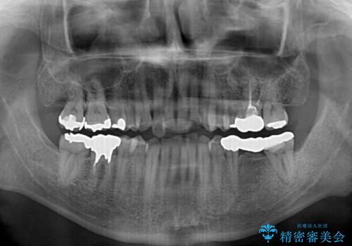 激痛の奥歯のむし歯治療　折角なので矯正治療もしたいの治療前