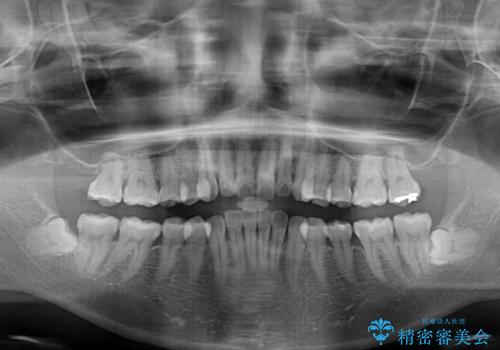 補助装置を用いて奥歯の咬み合わせを事前に改善 インビザラインによる矯正治療の治療前