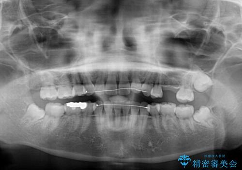 矯正の後戻りと奥歯の欠損　ワイヤー矯正とインプラント治療の治療前