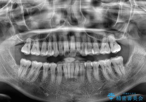 補助装置を用いて奥歯の咬み合わせを事前に改善 インビザラインによる矯正治療の治療後