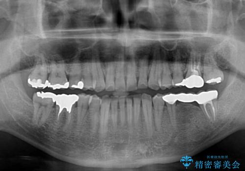 激痛の奥歯のむし歯治療 折角なので矯正治療もしたいの治療後