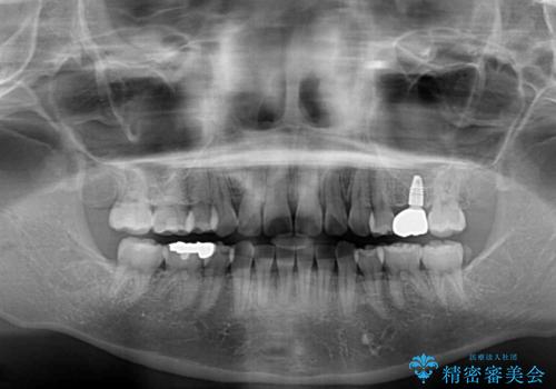 矯正の後戻りと奥歯の欠損 ワイヤー矯正とインプラント治療の治療後