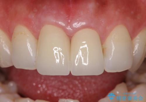 変色した歯を綺麗にしたい 根管治療からジルコニアクラウンでの修復の治療後