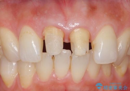 変色した歯を綺麗にしたい 根管治療からジルコニアクラウンでの修復の治療中