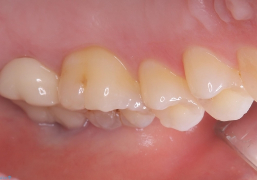 歯並びも綺麗になったし歯も白くしたいの治療後