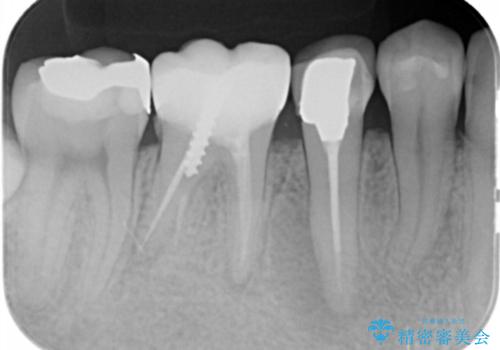 深い虫歯　セラミッククラウンの精度を高める歯周外科手術の治療前