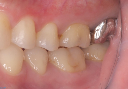 歯並びも綺麗になったし歯も白くしたいの治療前